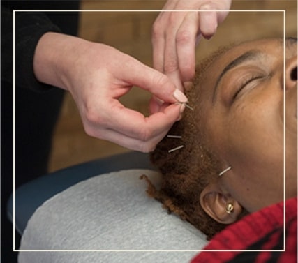 a female patient receiving dry needling treatment in her head at Active Edge Columbus Ohio